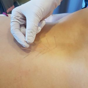 IGŁOTERAPIA- SUCHE IGŁOWANIE